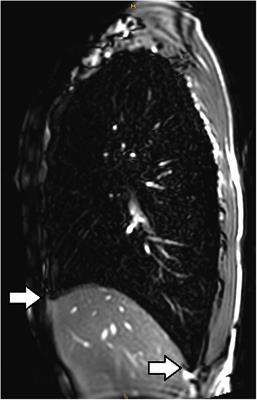 Going to Extremes of Lung Physiology–Deep Breath-Hold Diving